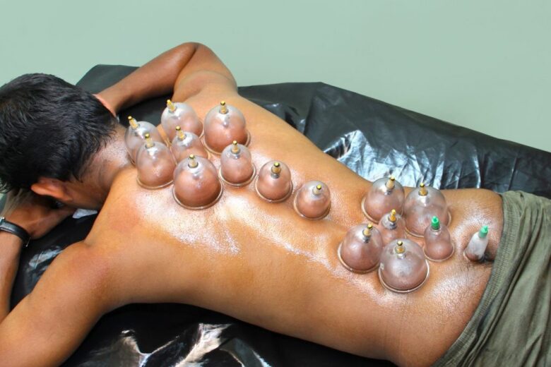 Cupping Therapy